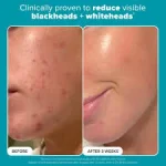 ژل ضدجوش سراوی مدل Blemish Control حجم 40میل - Image 2